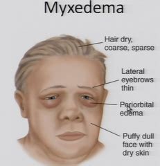 Pin on Hyperthyroidism & Hypothyroidism