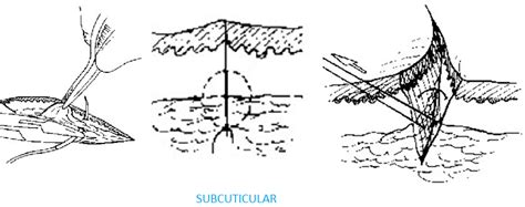 MBBS Medicine (Humanity First): SUTURE MATERIALS AND SUTURING TECHNIQUE