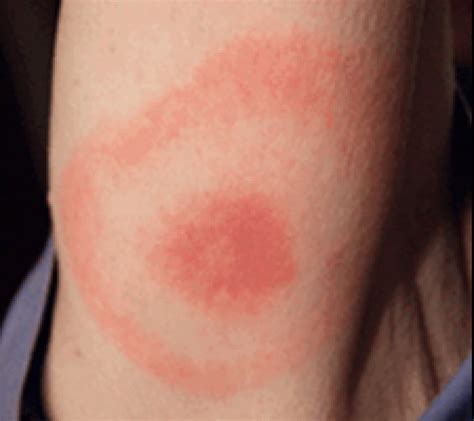 Citizen scientist's all-natural spray sends ticks running in first ...