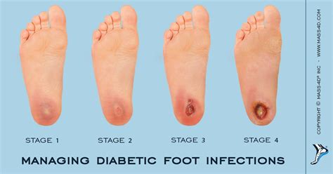 Does Diabetes Cause Sore Feet - DiabetesWalls