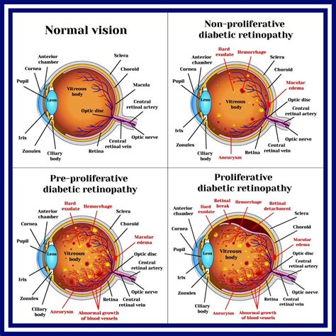 Diabetic Retinopathy Causes, Symptoms, Prevention, Diagnosis and ...