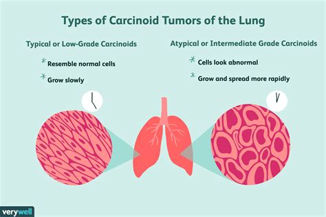 Types Of Lung Cancer Tumors