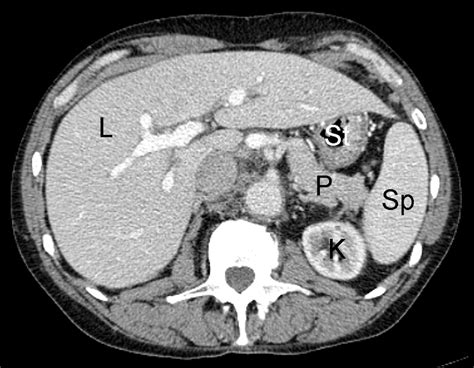 Normal Ct Scan Abdomen