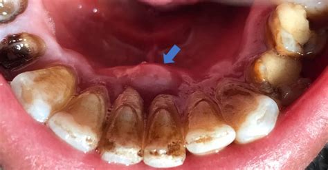 Periodontal Abscess Vs Periapical Abscess