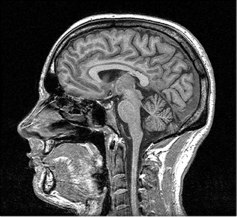 All Behaviour Is Meaning "Full": Traumatic Brain Injury: Blast-Induced ...