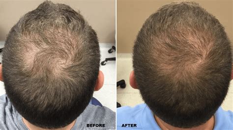 fue hair transplant after 20 days - Azzie Reaves