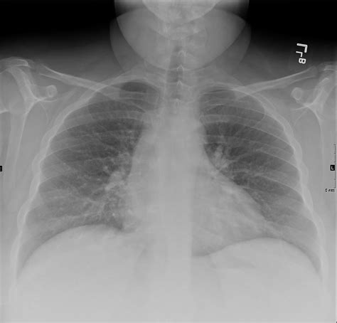 171Lu Acute Inhalational Crack Injury | Lungs