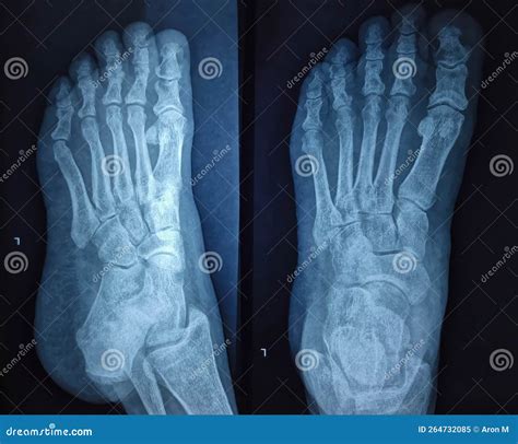 X-ray Image of Foot, Radiography of Food Bones Stock Image - Image of ...