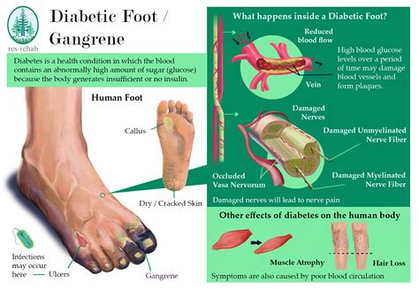 Diabetic Foot / Gangrene | Res Rehab