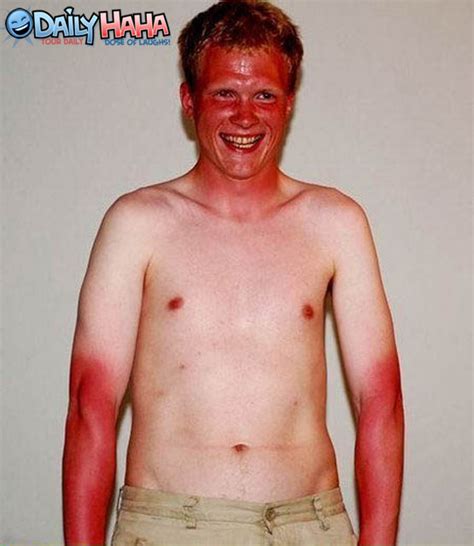 Nasty sunburn - Picture | eBaum's World