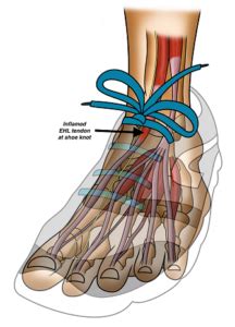 Great toe pain - RunBionic