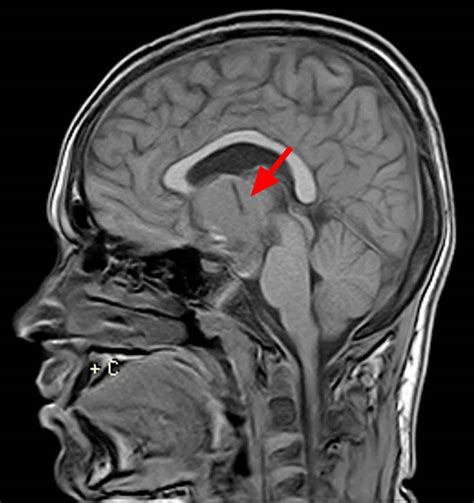 Craniopharyngioma types, causes, symptoms, diagnosis, treatment & prognosis