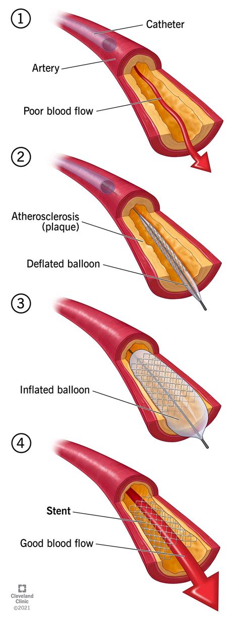 Stent: What They Are, Purpose and Risks