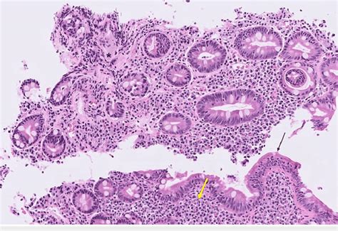 Cecum with transmural acute and chronic inflammation, focal mucosal ...