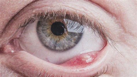 Stye On Upper Eyelid - Latest News