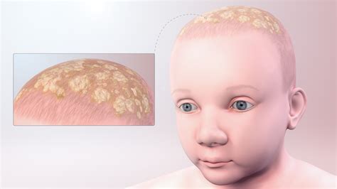 Cradle Cap: Symptoms, Causes, and Treatment - Scientific Animations