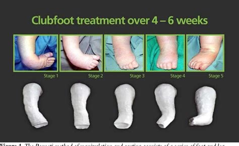 Figure 4 from Congenital Talipes Equinovarus : A Case Report Of ...