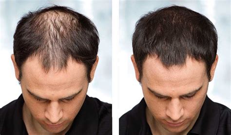 Effective Hair Loss Treatments for Men and Women