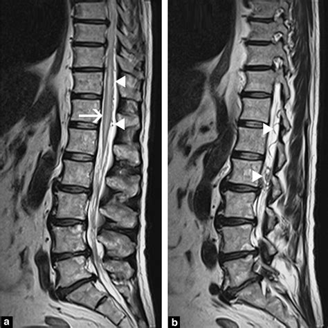 T2-weighted spinal cord MRI centered on the lumbosacral region ...