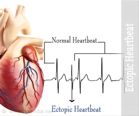 How To Get Rid Of Ectopic Beats - Temporaryatmosphere32