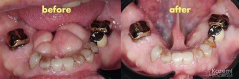 Removal of Very Large Mandibular Tori | Removal of Very Large ...