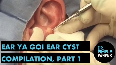 Ear Ya GO! 👂🏽Ear Cyst Compilation Part I - Dr. Pimple Popper