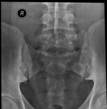 Sacroiliac Joint Xray