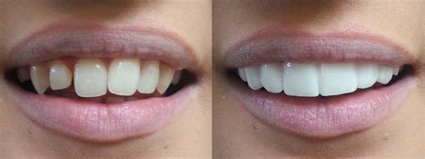 Porcelain Veneers at Roy and Syracuse | Lakeview Dental