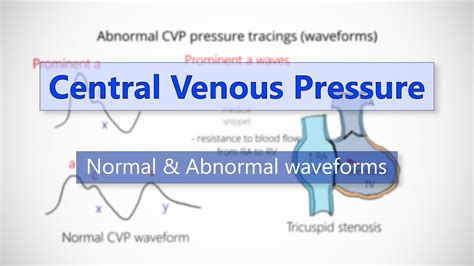 Central Venous Pressure (CVP) waveforms - YouTube