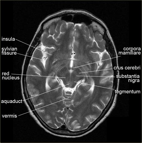 Brain Anatomy On Mri - Anatomy Reading Source