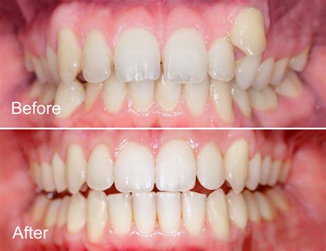 clear-aligners-before-after-2-AdobeStock_573993958 - Lansdowne, VA ...