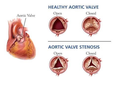 Aortic Valve Replacement - CTVS Jacksonville