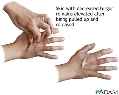 Skin turgor: MedlinePlus Medical Encyclopedia