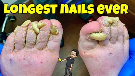 World Longest Toenails