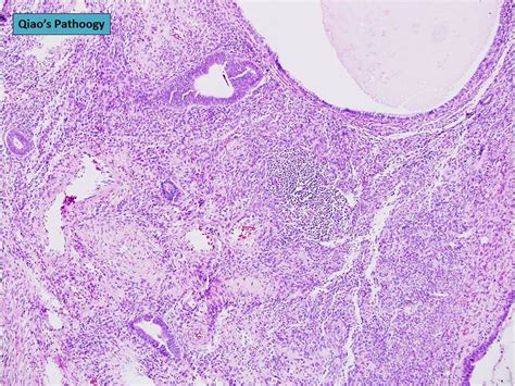 Cervical Polyp Types