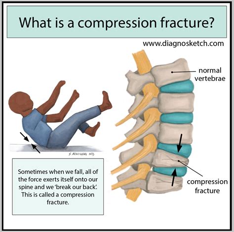 What is a compression fracture? - by Sapana Adhikari, MD