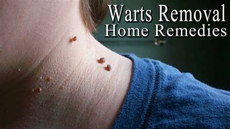 Warts - 5 Simple Home Remedies to Get Rid of Facial Warts Naturally ...