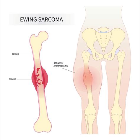 Ewing Sarcoma: Causes, Risk Factors, Symptoms, Treatment