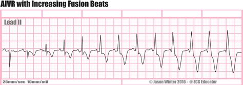 ECG Educator Blog : Accelerated Idioventricular Rhythm (AIVR)