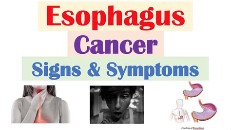 Esophageal Cancer Signs & Symptoms (& Why They Occur) - YouTube