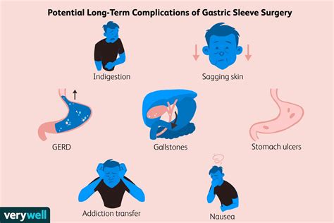 Long-Term Complications After Gastric Sleeve Surgery