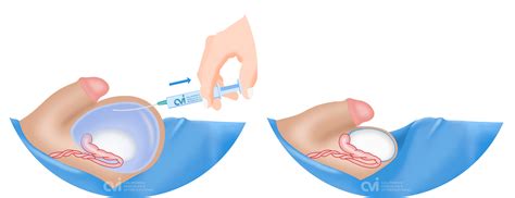 Hydrocele Drainage Procedure - Best Drain Photos Primagem.Org