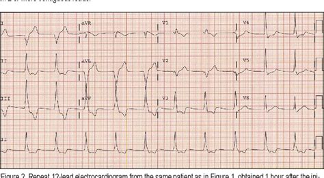 Figure 2 from ECG Diagnosis: Accelerated Idioventricular Rhythm ...