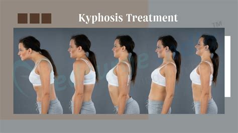 Kyphosis Surgery Cost In India | Procedure | Medsurge India