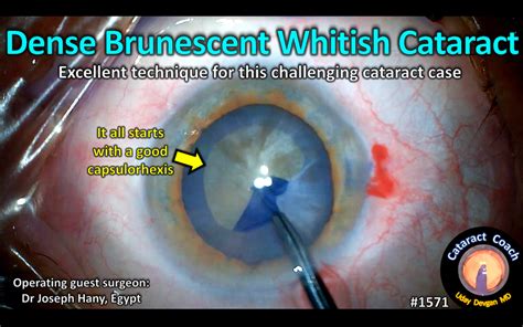 1571: dense brunescent whitish cataract – Cataract Coach