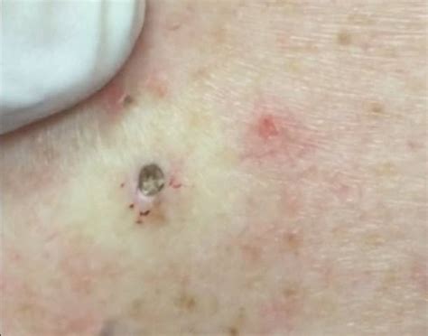 Watch this Dr Pimple Popper huge blackhead unleashed.