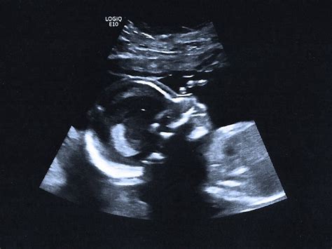 20-week ultrasound: Pictures, procedure, and more