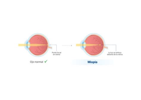 Dioptrías de miopía: ¿qué son y cómo se miden? - Ejercicio para la salud