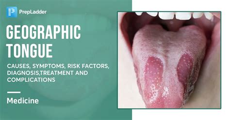 Geographic Tongue: Causes, Symptoms, Diagnosis and Treatment