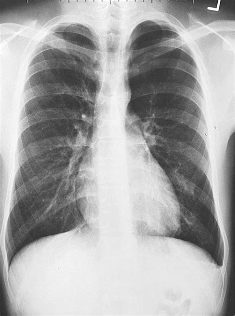 Study Medical Photos: Primary Spontaneous Pneumothorax - Chest X ray